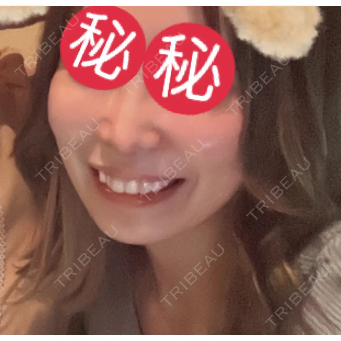 糸リフト / ヒアルロン酸注入（目の下） 湘南美容クリニック 辻堂アカデミア AFTER