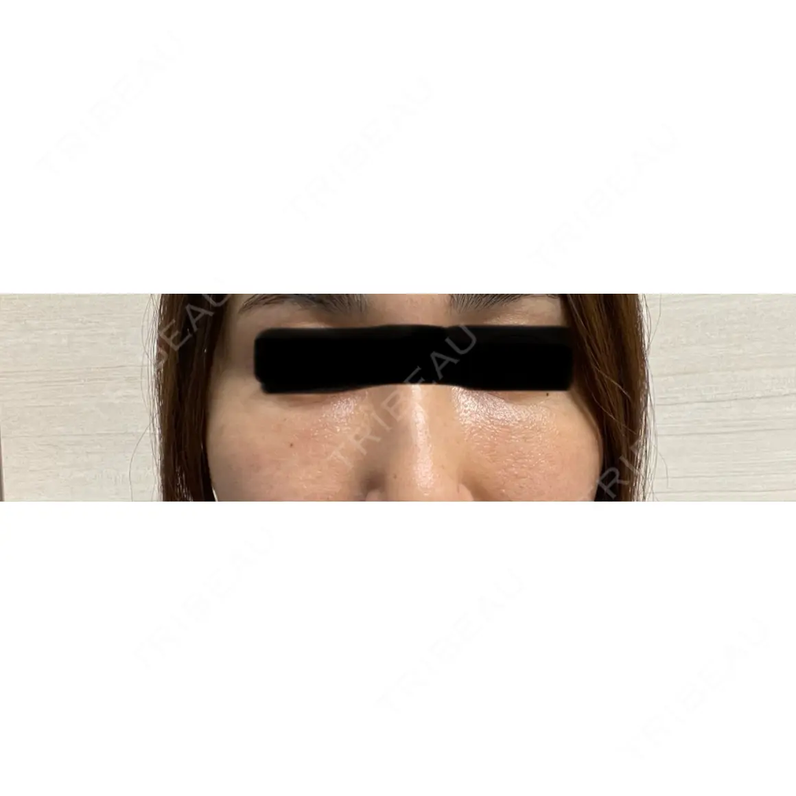 クマ治療 / 下まぶたたるみ取り / 下まぶたの脂肪取り / 脂肪注入（肌） アリエル美容クリニック 大宮院 AFTER