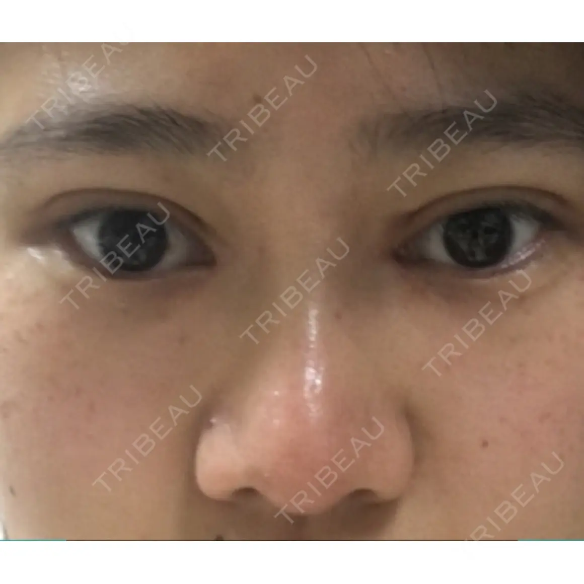 二重埋没 / 二重切開 / 目頭切開 / 眼瞼下垂（切開） / 隆鼻術 / 鼻尖形成（切開） / 鼻中隔延長（切開） / 上まぶたたるみ取り / 軟骨移植 湘南美容クリニック 新宿本院 DAY 31