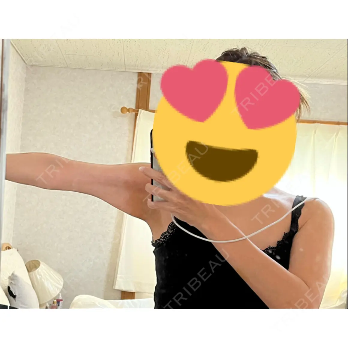 脂肪吸引（二の腕） くさのたろうクリニック AFTER