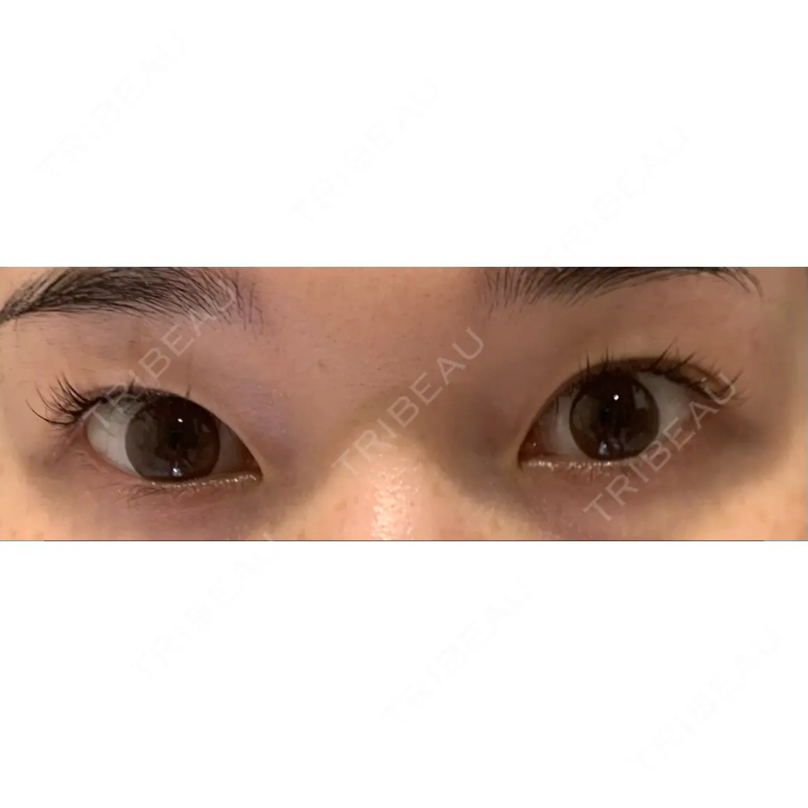 二重埋没 BIANCA銀座 AFTER