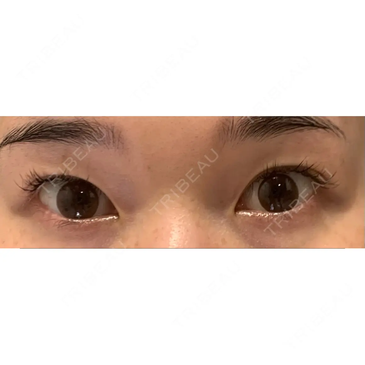 二重埋没 BIANCA銀座 AFTER