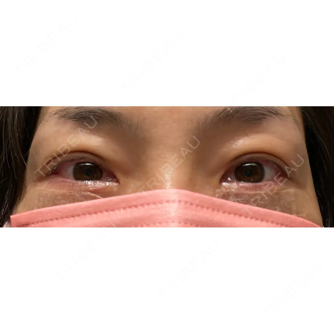 二重埋没 / 下まぶたたるみ取り / 下まぶたの脂肪取り お茶の水美容形成クリニック DAY 0