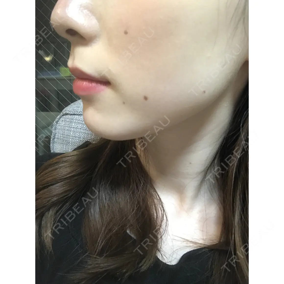 ボトックス（エラ・小顔） 湘南美容クリニック 新宿本院 DAY 0