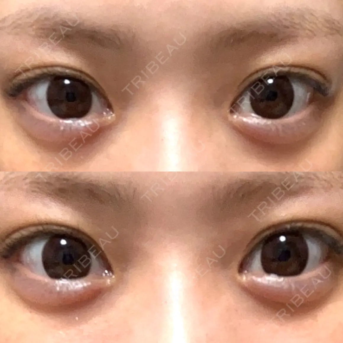 ヒアルロン酸注入（涙袋） フィラークリニック 大阪心斎橋院 AFTER