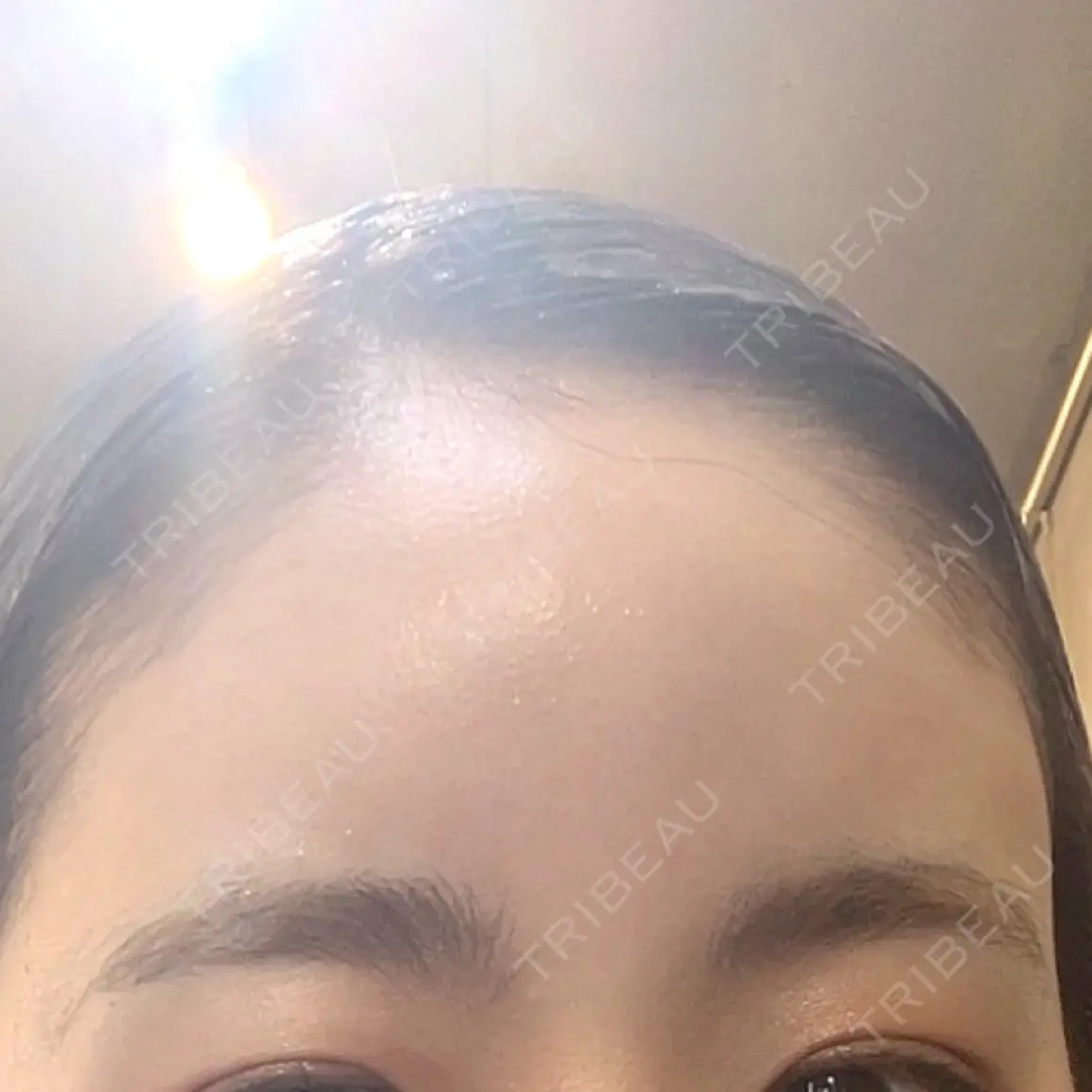 ヒアルロン酸注入（額） 藤・ナチュレ美容クリニック 恵比寿院 AFTER