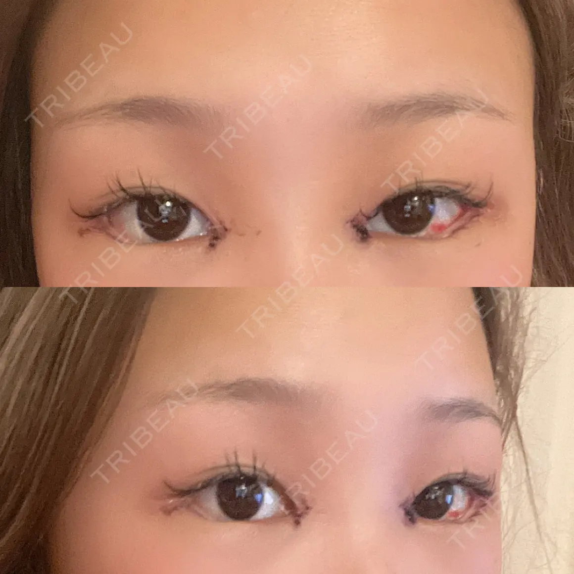 目頭切開 / 糸リフト / タレ目形成・グラマラスライン（切開） HAAB×DREAM BEAUTY CLINIC 大阪梅田院 DAY 1