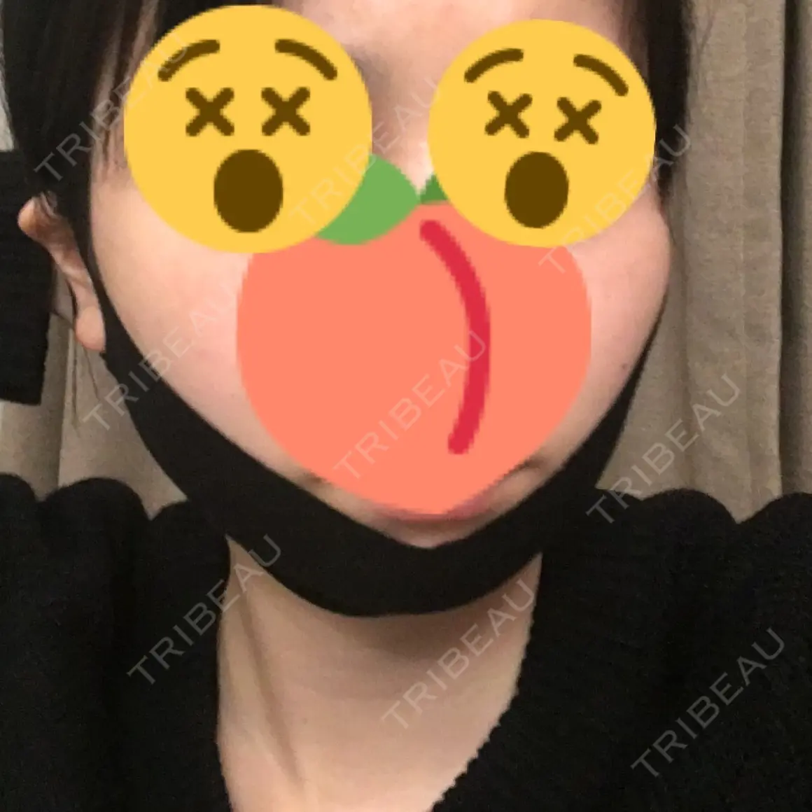 脂肪溶解注射（顔） / ハイフ（顔） リエンジャン整形外科 江南店 DAY 0
