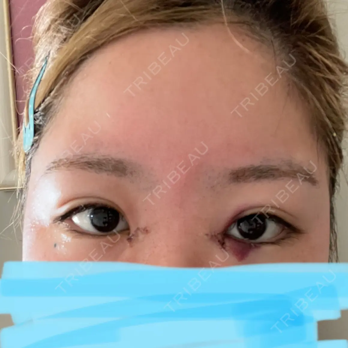 蒙古ひだ形成 VENUS BEAUTY CLINIC　銀座院 DAY 1