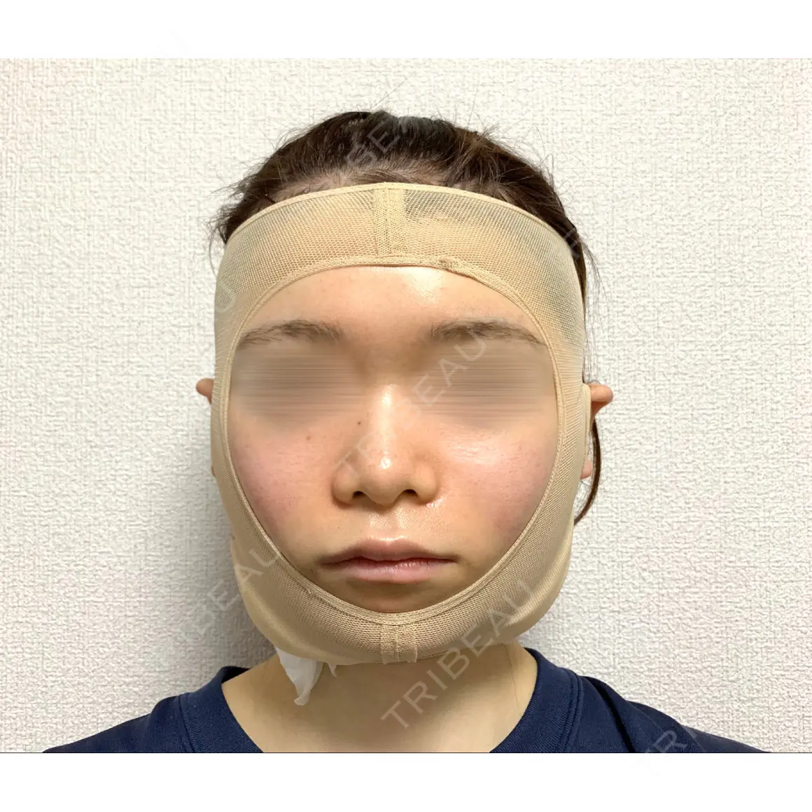 糸リフト / バッカルファット除去 / 脂肪吸引（顔） / ボトックス（あご） / ヒアルロン酸注入（あご） / ボトックス（エラ・小顔） / ヒアルロン酸注入（唇） / その他（口元） アリエル美容クリニック 大宮院 DAY 0