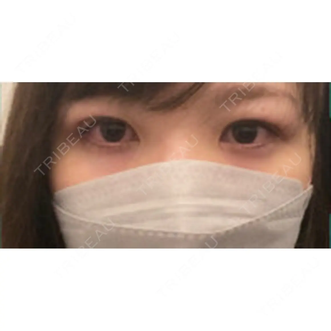 二重埋没 オアシス美容外科 DAY 0