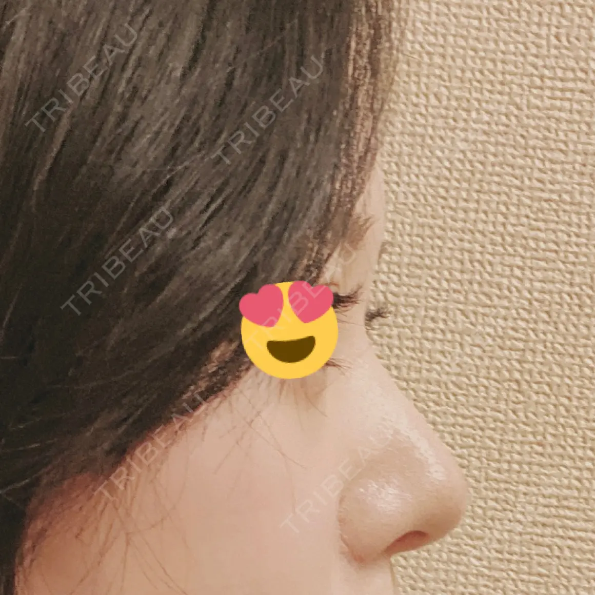 隆鼻術 / 鼻中隔延長（切開） / 眉間プロテーゼ プリモ麻布十番クリニック AFTER