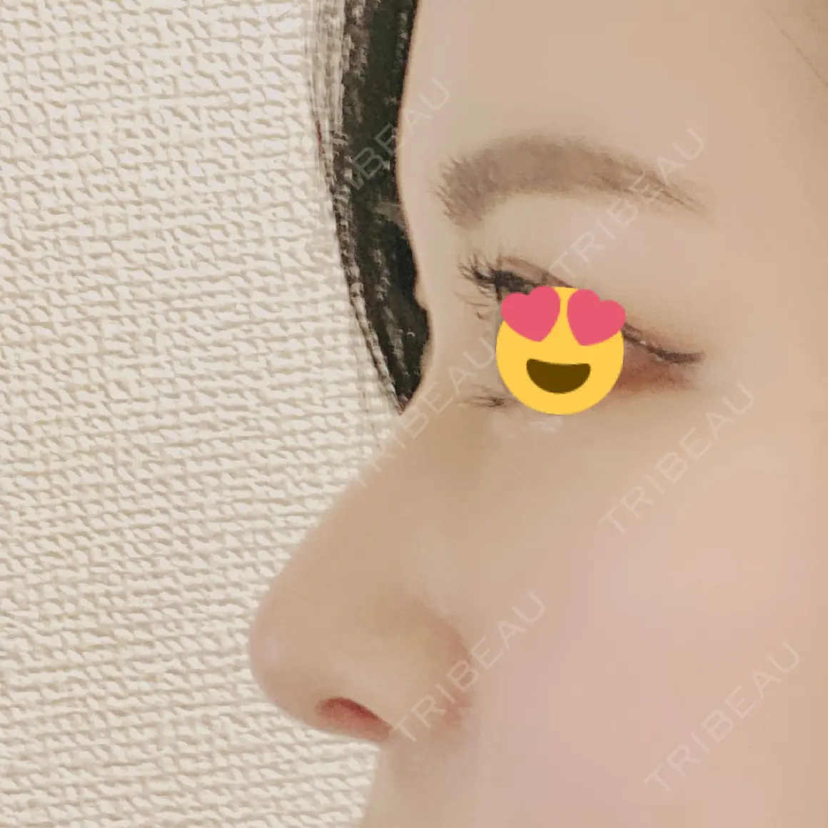 隆鼻術 / 鼻中隔延長（切開） / 眉間プロテーゼ プリモ麻布十番クリニック AFTER