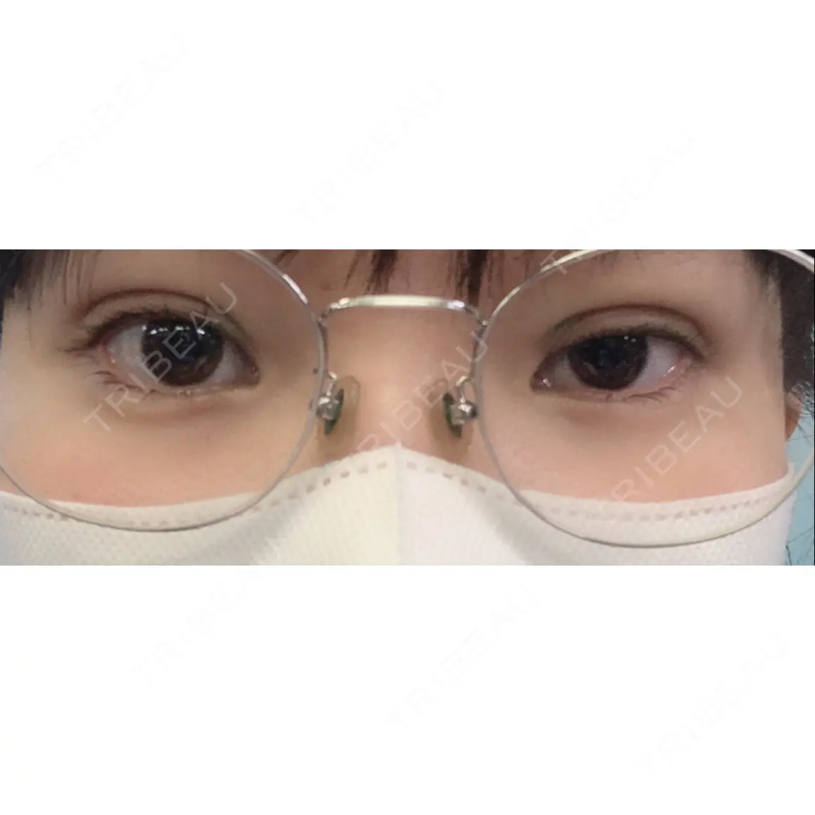二重埋没 ルラ美容クリニック 新宿院 DAY 0