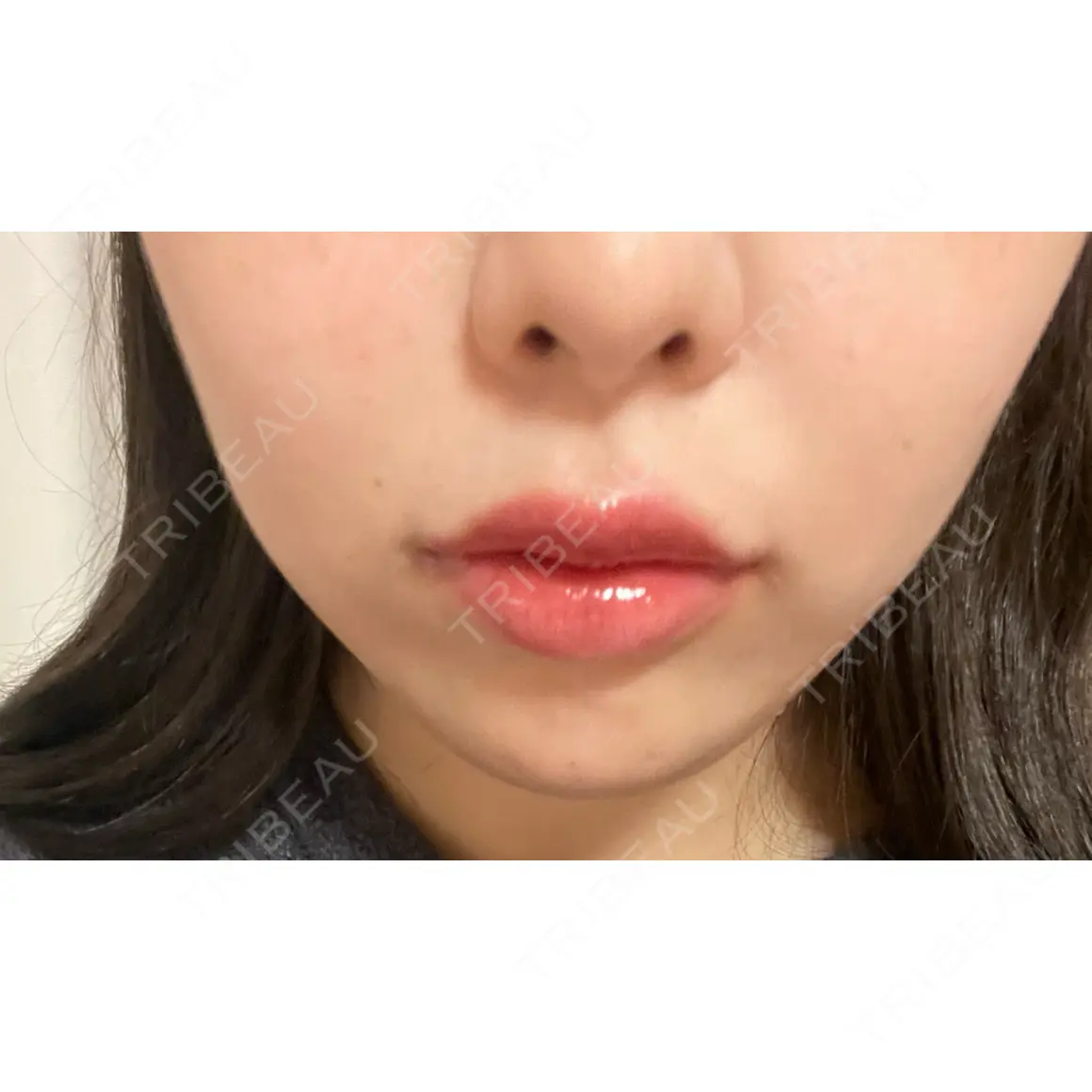 ボトックス（あご） / ヒアルロン酸注入（あご） / 脂肪溶解注射（顔） / ヒアルロン酸注入（唇） / ボトックス（口角） ルラ美容クリニック 新宿院 DAY 0