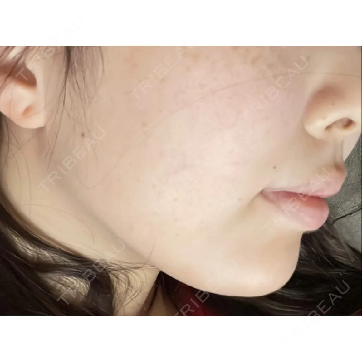 ボトックス（あご） / ヒアルロン酸注入（あご） / 脂肪溶解注射（顔） / ヒアルロン酸注入（唇） / ボトックス（口角） ルラ美容クリニック 新宿院 AFTER