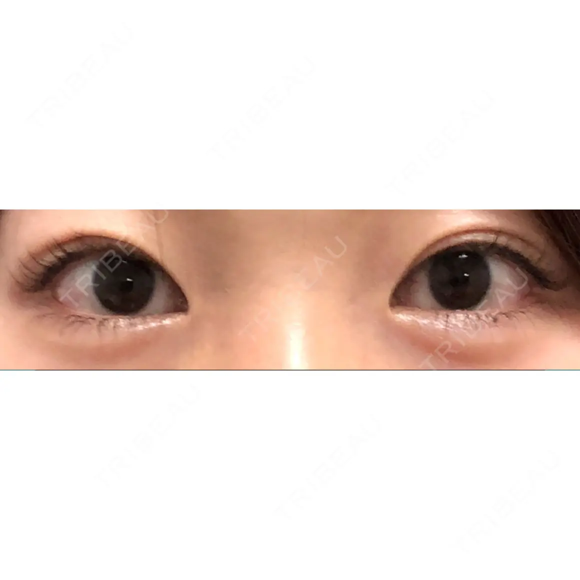 二重埋没 お茶の水美容形成クリニック AFTER
