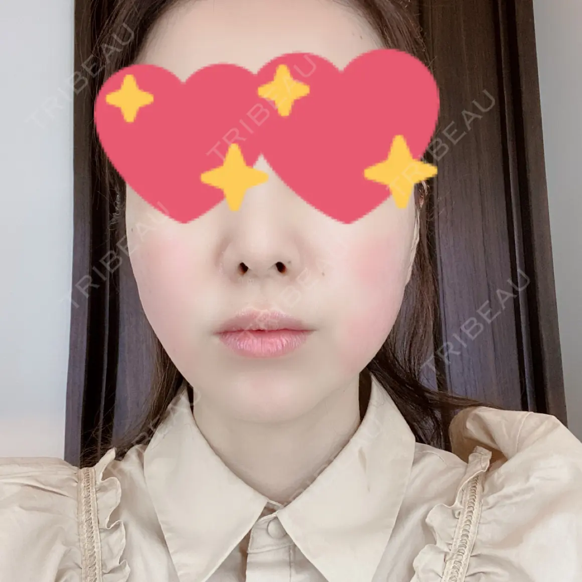 ハイフ（顔） 新宿中央クリニック DAY 0