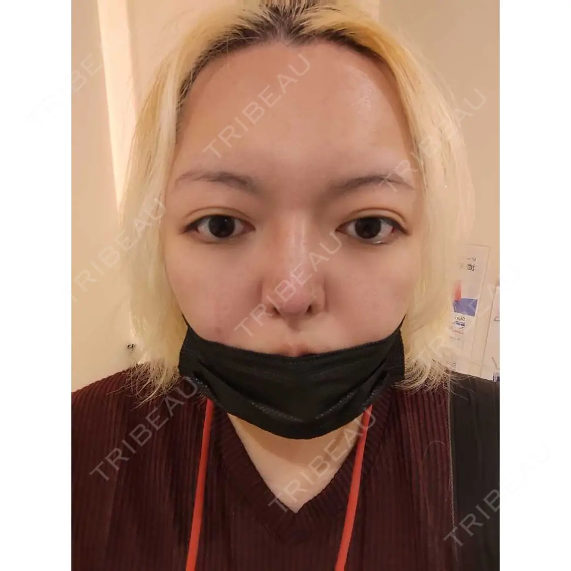 鼻尖縮小 / 鼻尖形成（非切開） 品川美容外科 新宿院（※品川スキンクリニック提携） DAY 0