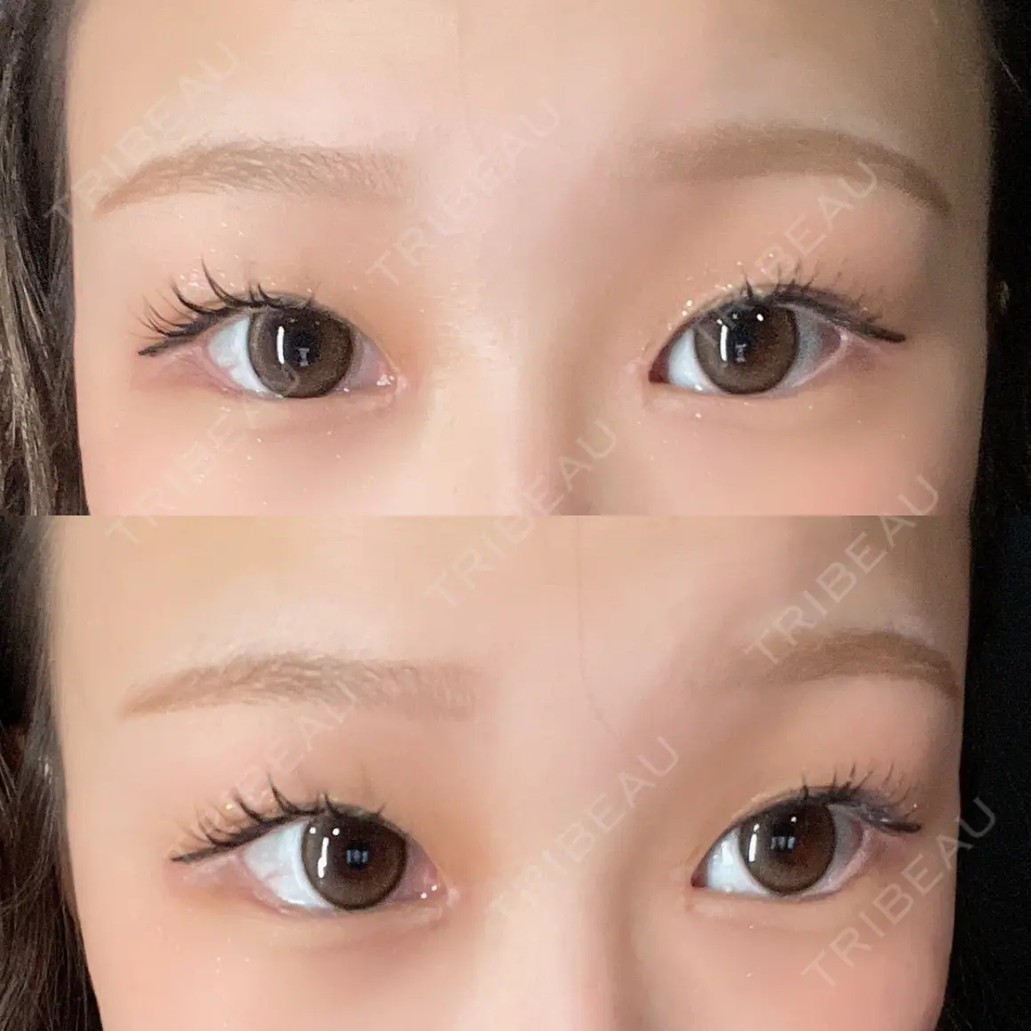 目頭切開 / 糸リフト / タレ目形成・グラマラスライン（切開） HAAB×DREAM BEAUTY CLINIC 大阪梅田院 AFTER
