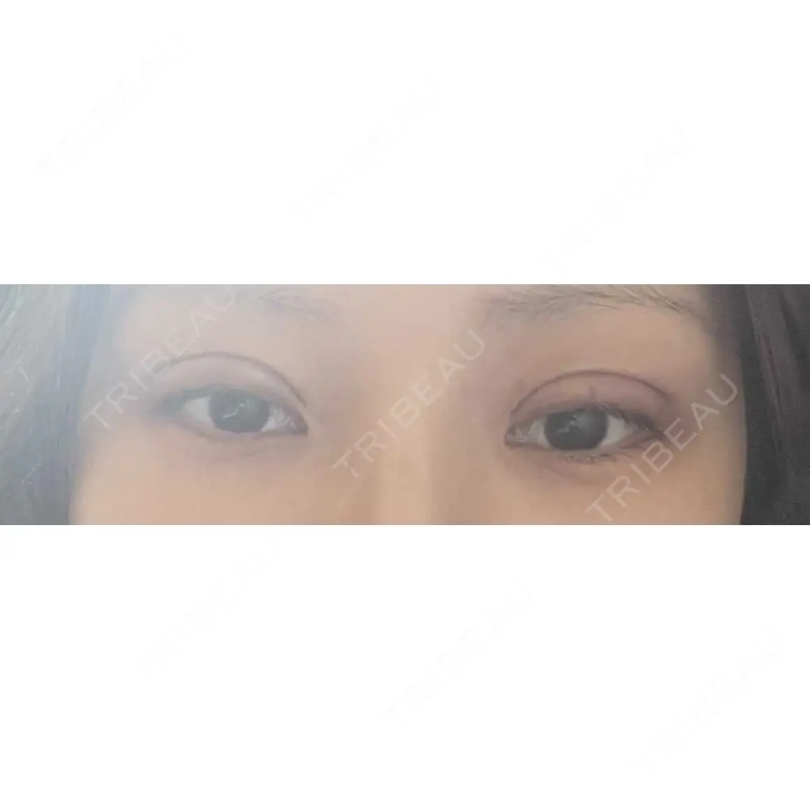 二重埋没 プロミス整形外科 DAY 1