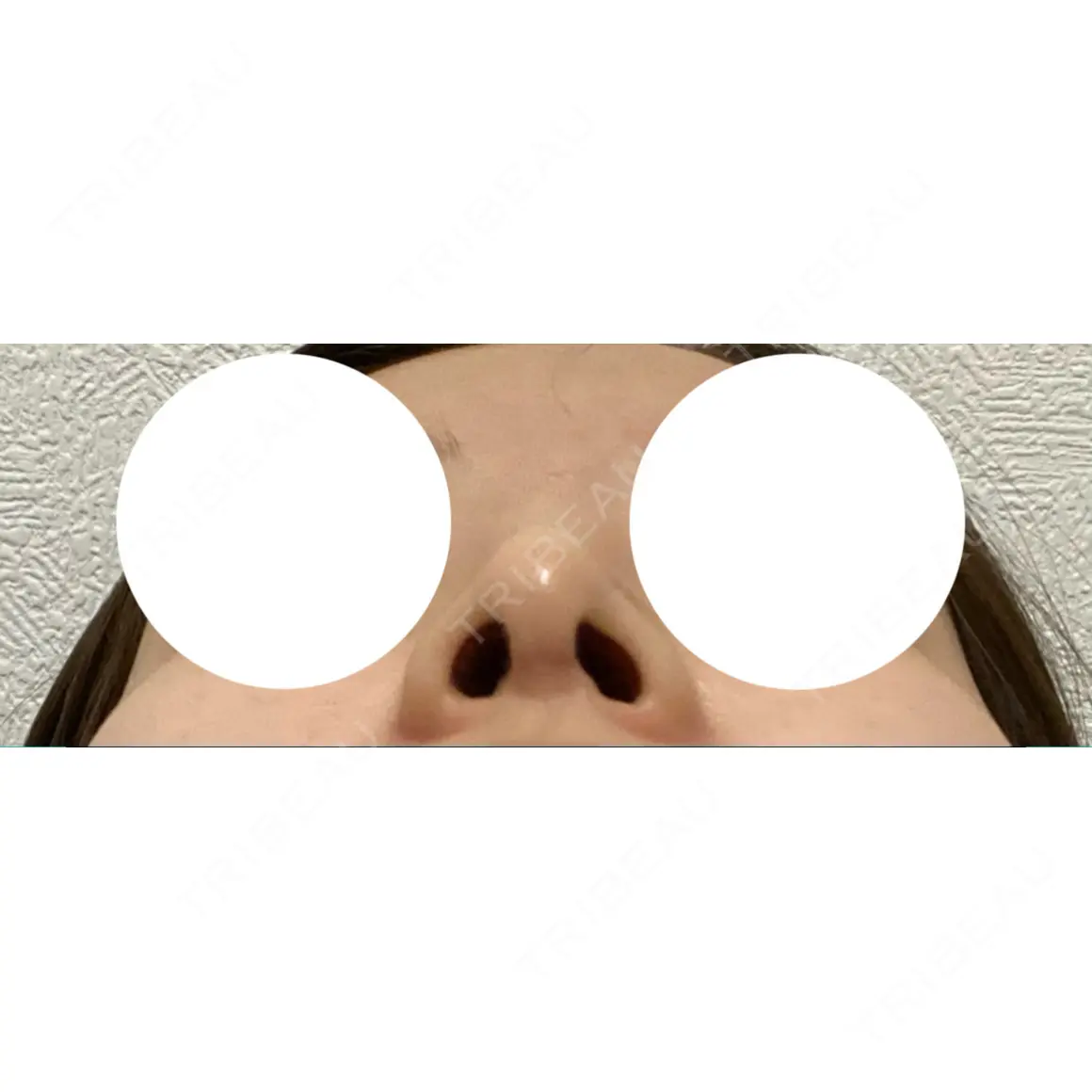 鼻尖形成（切開） / 糸リフト / 軟骨移植 / ヒアルロン酸注入（あご） / ボトックス（エラ・小顔） / シワ取りボトックス アリエル美容クリニック 大宮院 AFTER