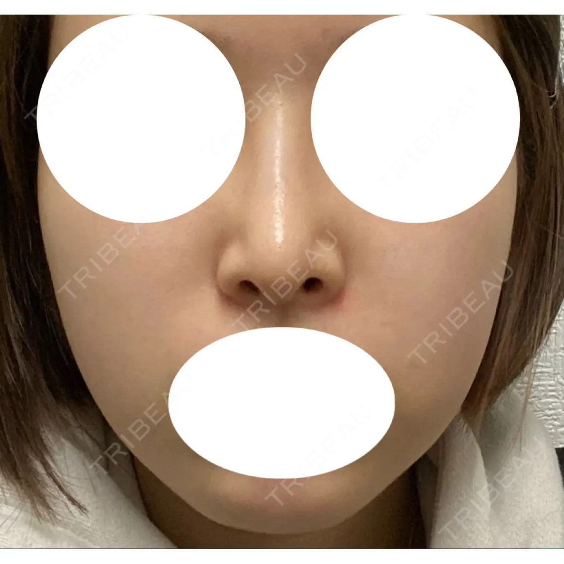 鼻尖形成（切開） / 糸リフト / 軟骨移植 / ヒアルロン酸注入（あご） / ボトックス（エラ・小顔） / シワ取りボトックス アリエル美容クリニック 大宮院 AFTER