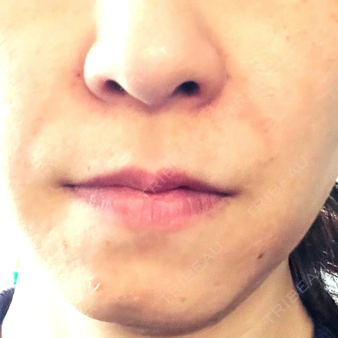 PRP皮膚再生療法 聖心美容クリニック 札幌院 DAY 0
