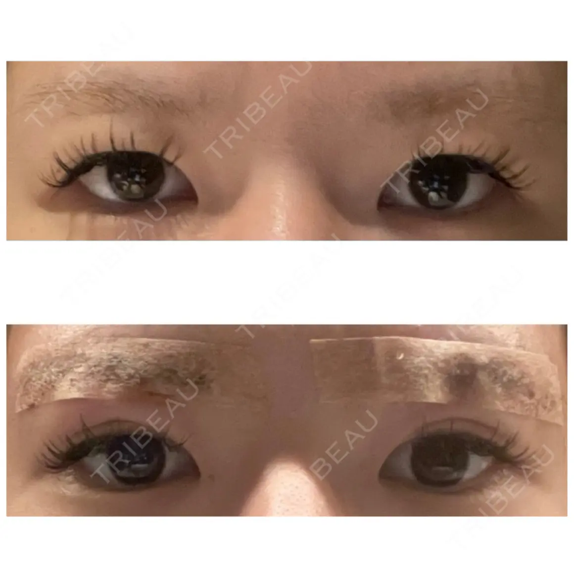 眉下切開 Taide Suenaga Clinic（タイデスエナガクリニック） DAY 0