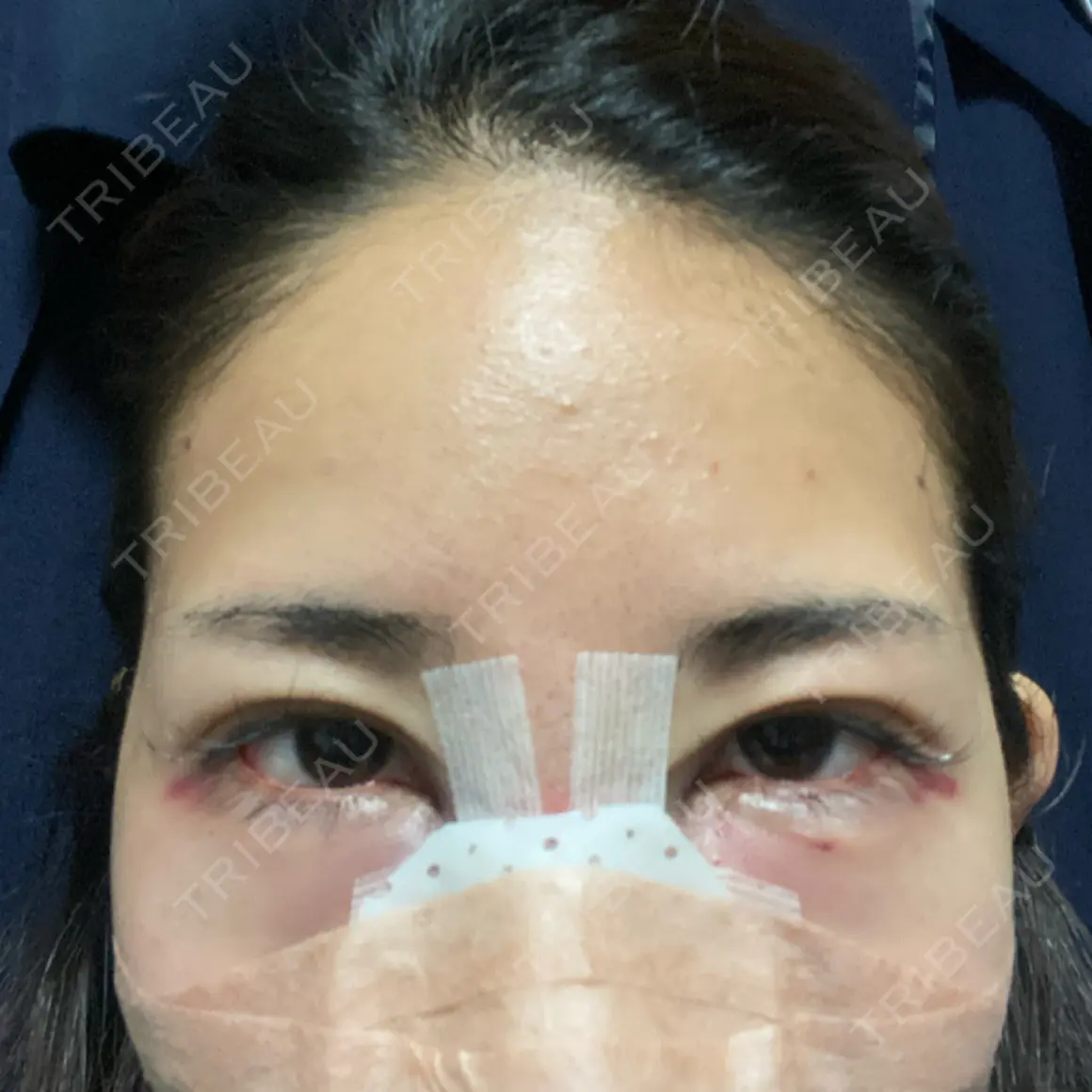 鼻尖形成（切開） / ワシ鼻修正・ハンプ切除 HAAB×DREAM BEAUTY CLINIC 大阪梅田院 DAY 0