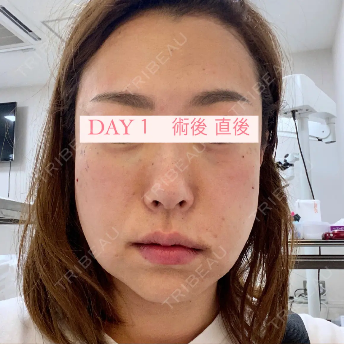 クマ治療 / 脂肪吸引（顔） / 下まぶたたるみ取り / 下まぶたの脂肪取り / 脂肪注入（肌） / ジョールファット除去 / あご下筋肉縛り Wi Clinic（ウィ クリニック） 大宮院 DAY -31