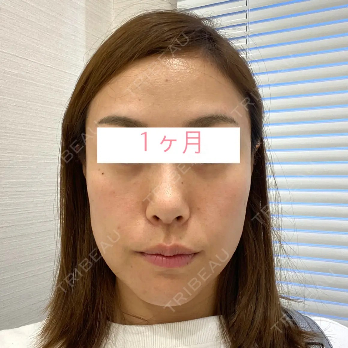クマ治療 / 脂肪吸引（顔） / 下まぶたたるみ取り / 下まぶたの脂肪取り / 脂肪注入（肌） / ジョールファット除去 / あご下筋肉縛り Wi Clinic（ウィ クリニック） 大宮院 AFTER