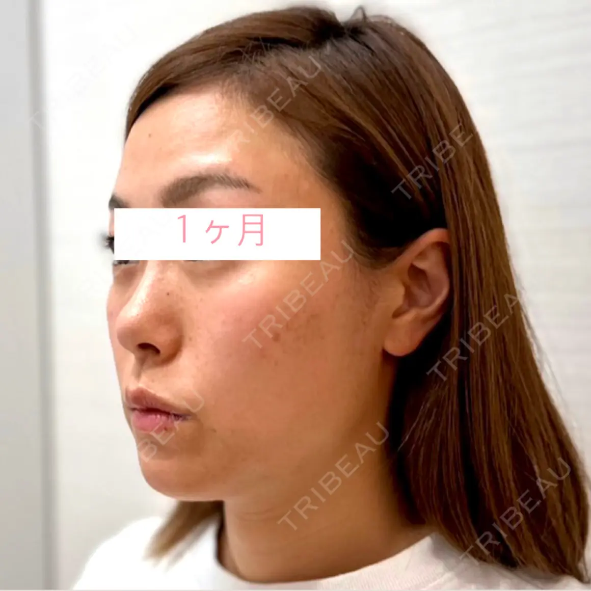 クマ治療 / 脂肪吸引（顔） / 下まぶたたるみ取り / 下まぶたの脂肪取り / 脂肪注入（肌） / ジョールファット除去 / あご下筋肉縛り Wi Clinic（ウィ クリニック） 大宮院 AFTER