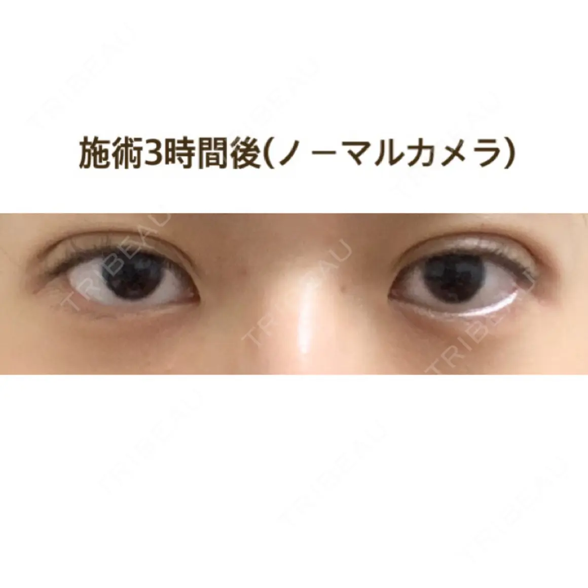 二重埋没 ルラ美容クリニック 高田馬場院 DAY 0
