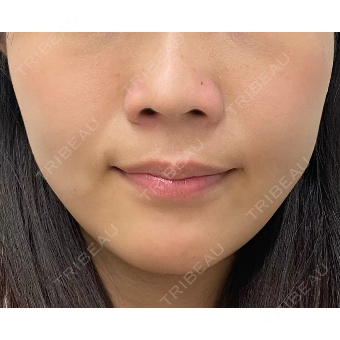 小鼻縮小（非切開） AI Beauty Clinic （エーアイ美容クリニック） DAY 0
