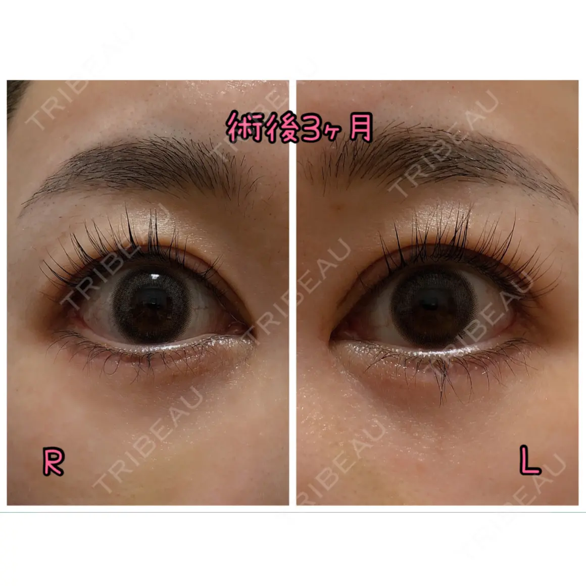 二重切開 / 目頭切開 / 眼瞼下垂（切開） / 目尻切開 / タレ目形成・グラマラスライン（切開） eクリニック 金沢本院 AFTER