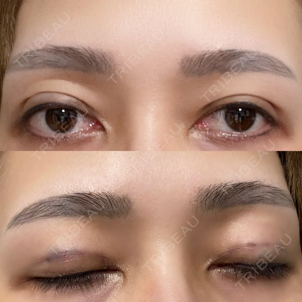 二重埋没 HAAB×DREAM BEAUTY CLINIC 大阪梅田院 DAY 0
