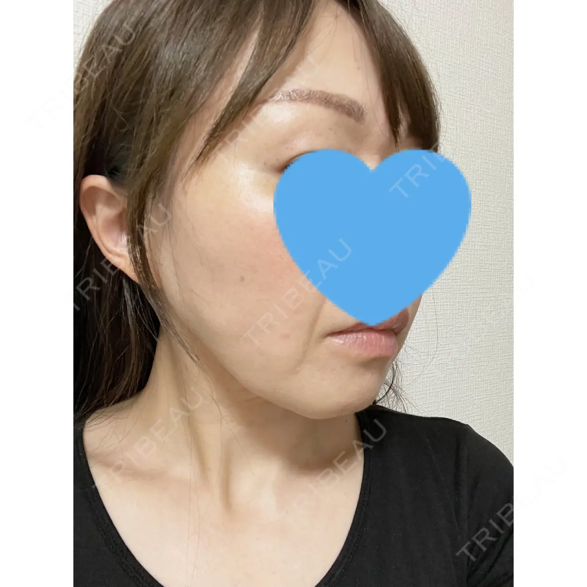 脂肪注入（輪郭） THE CLINIC（ザ・クリニック） 名古屋院 AFTER