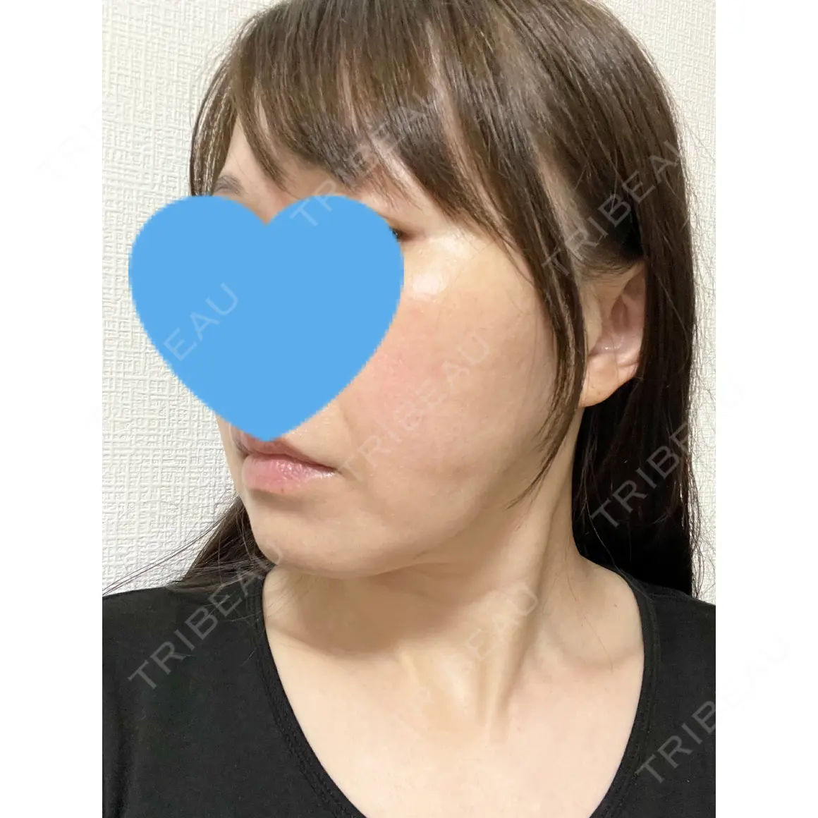 脂肪注入（輪郭） THE CLINIC（ザ・クリニック） 名古屋院 AFTER