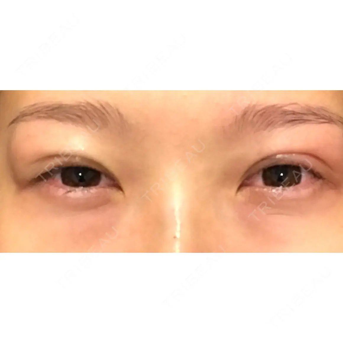 二重埋没 プレシャスクリニック自由が丘 DAY 0