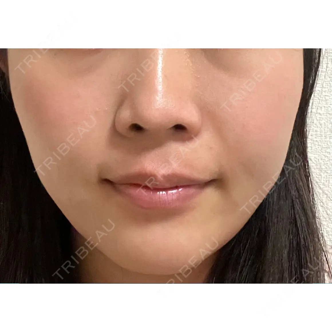 小鼻縮小（非切開） AI Beauty Clinic （エーアイ美容クリニック） AFTER