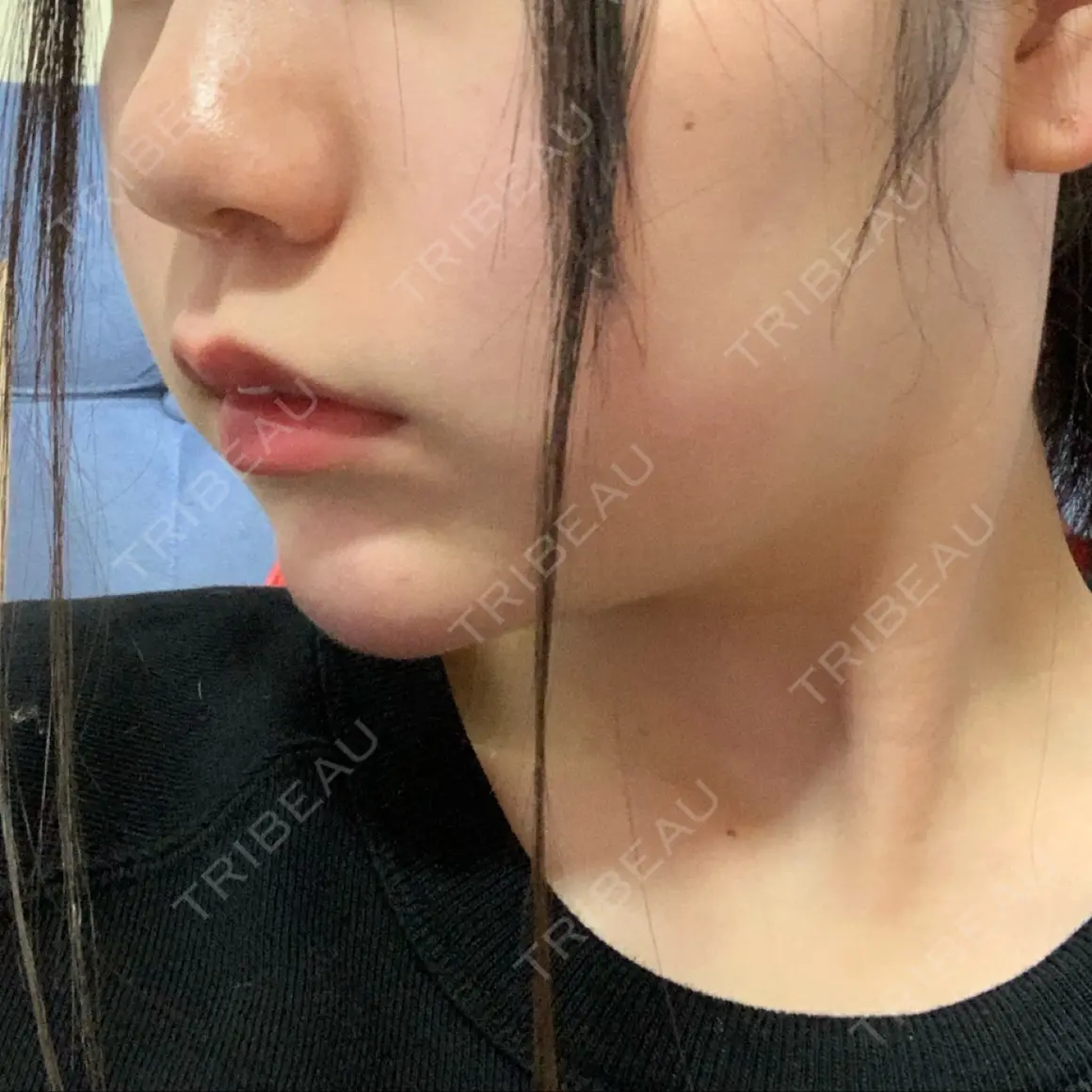 ヒアルロン酸注入（あご） / ボトックス（エラ・小顔） 品川スキンクリニック 宇都宮院（※品川美容外科提携） AFTER