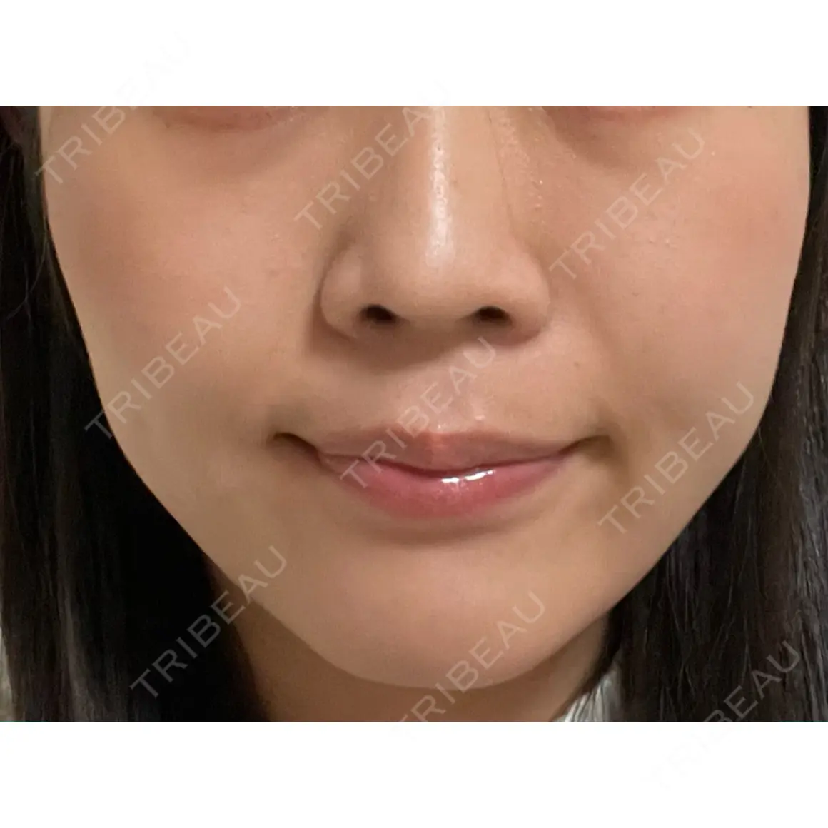 小鼻縮小（非切開） AI Beauty Clinic （エーアイ美容クリニック） AFTER
