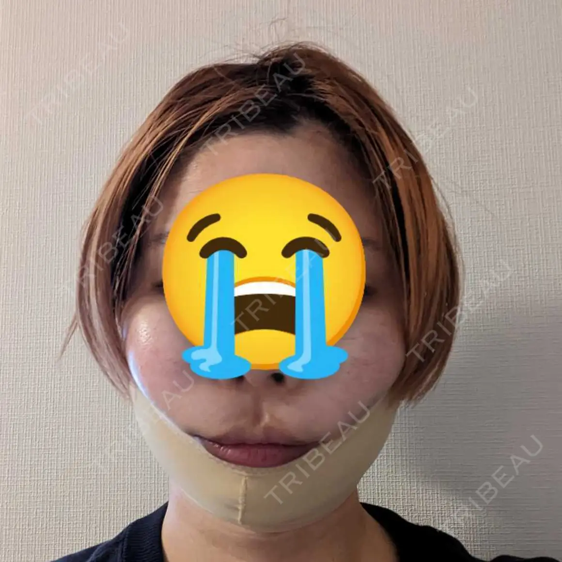 脂肪吸引（顔） / メーラーファット除去 / ジョールファット除去 ブルームクリニック（BLOOM CLINIC） DAY 0