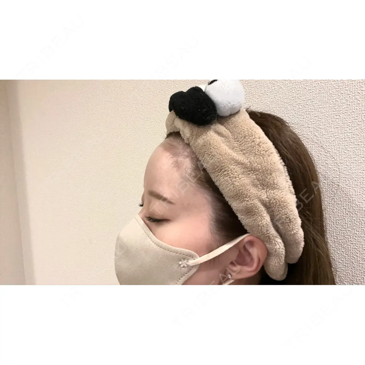 ヒアルロン酸注入（額） / ヒアルロン酸注入（こめかみ） 渋谷美容外科クリニック 新宿院 AFTER