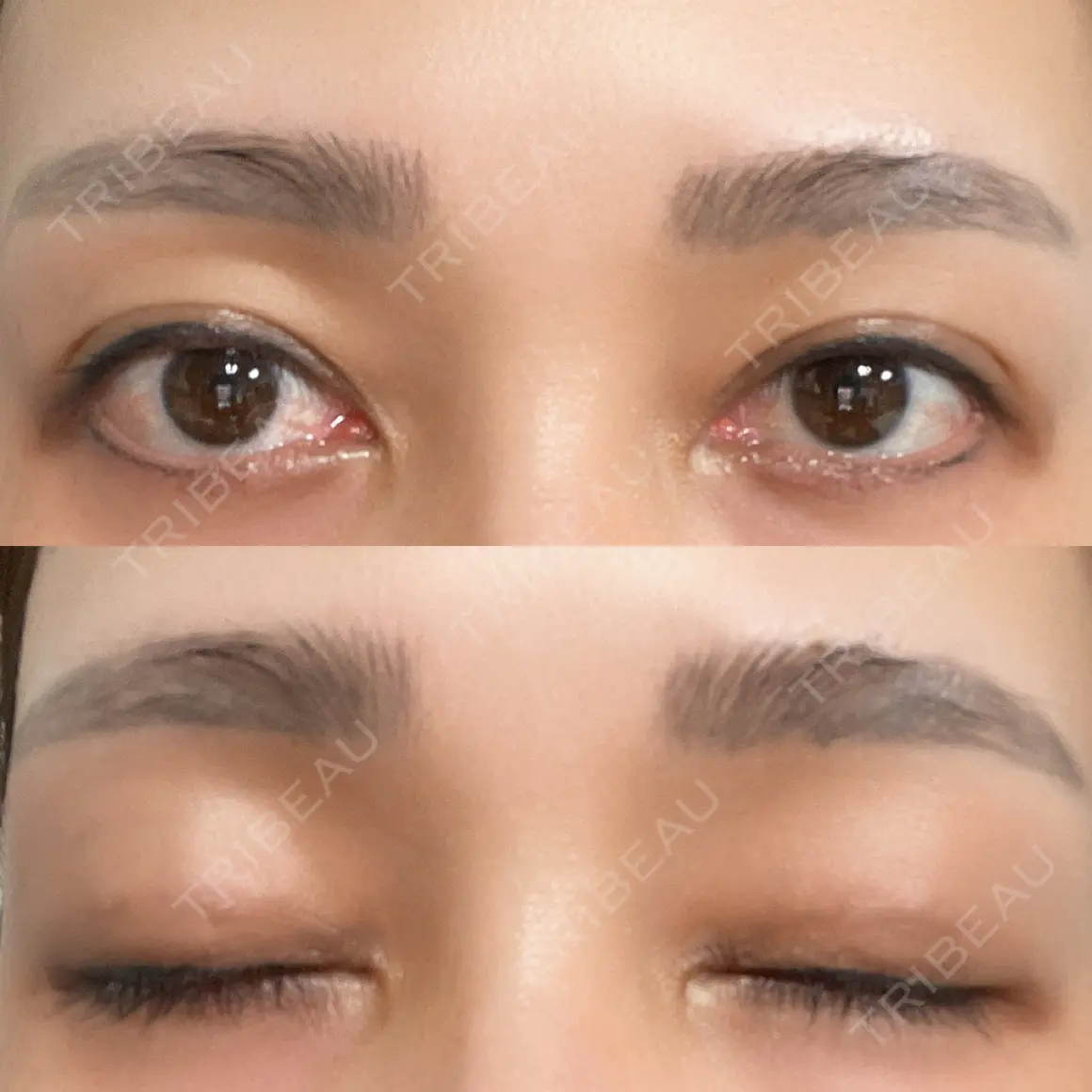 二重埋没 HAAB×DREAM BEAUTY CLINIC 大阪梅田院 AFTER