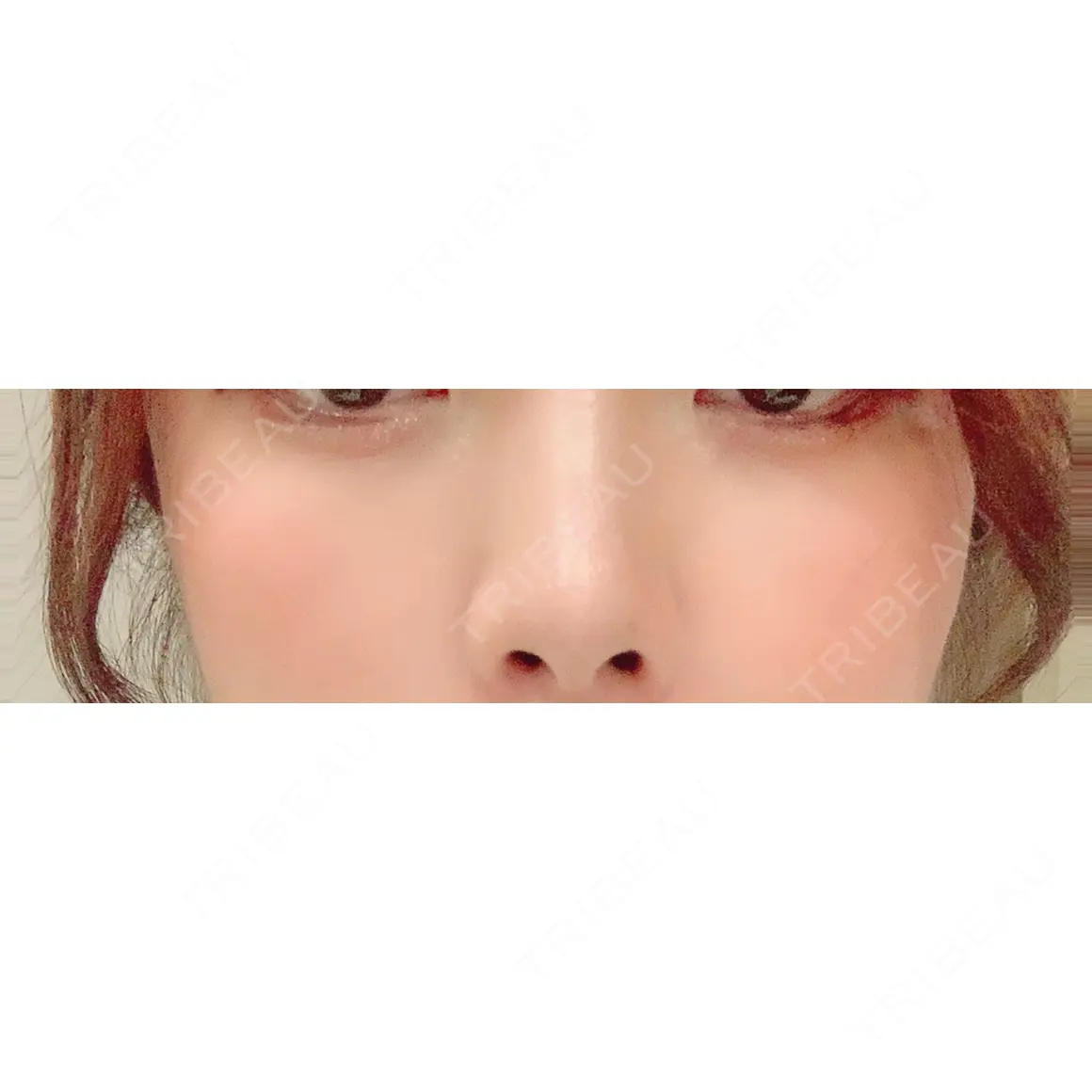 ヒアルロン酸注入（涙袋） / ヒアルロン酸注入（鼻） BIANCA表参道 AFTER