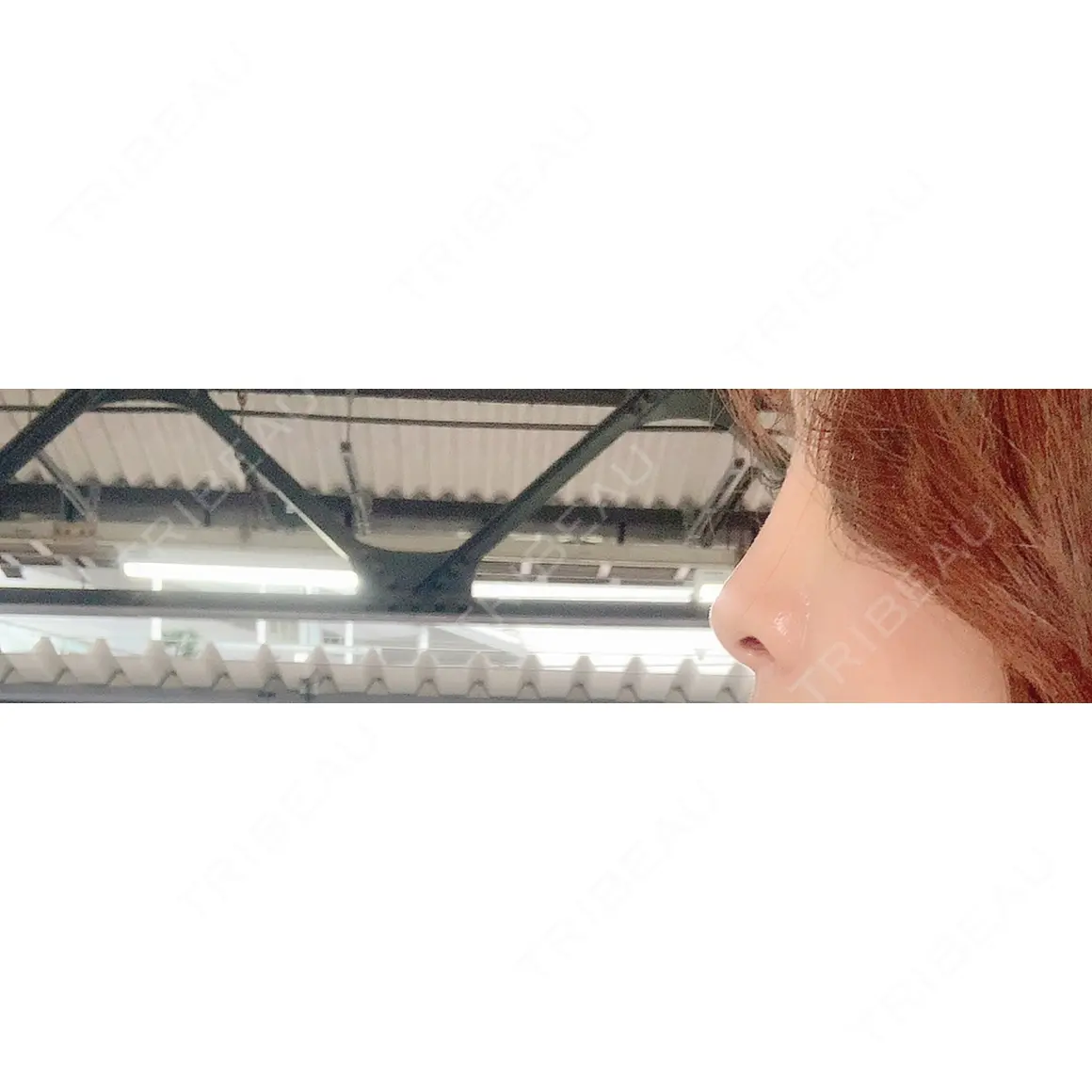 ヒアルロン酸注入（涙袋） / ヒアルロン酸注入（鼻） BIANCA表参道 AFTER
