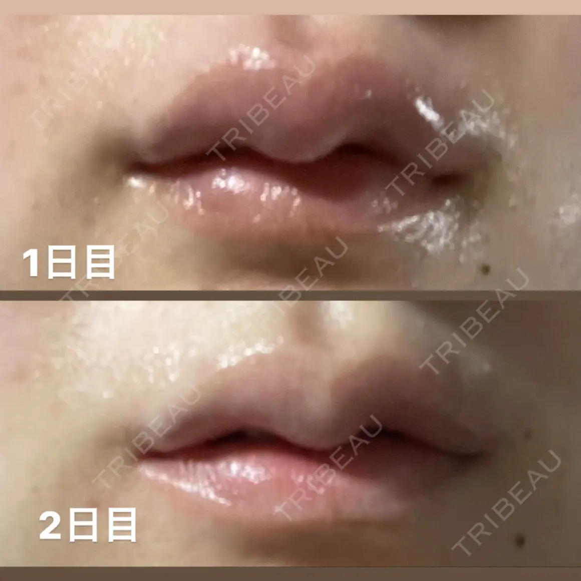 ヒアルロン酸注入（唇） 渋谷美容外科クリニック 新宿院 AFTER