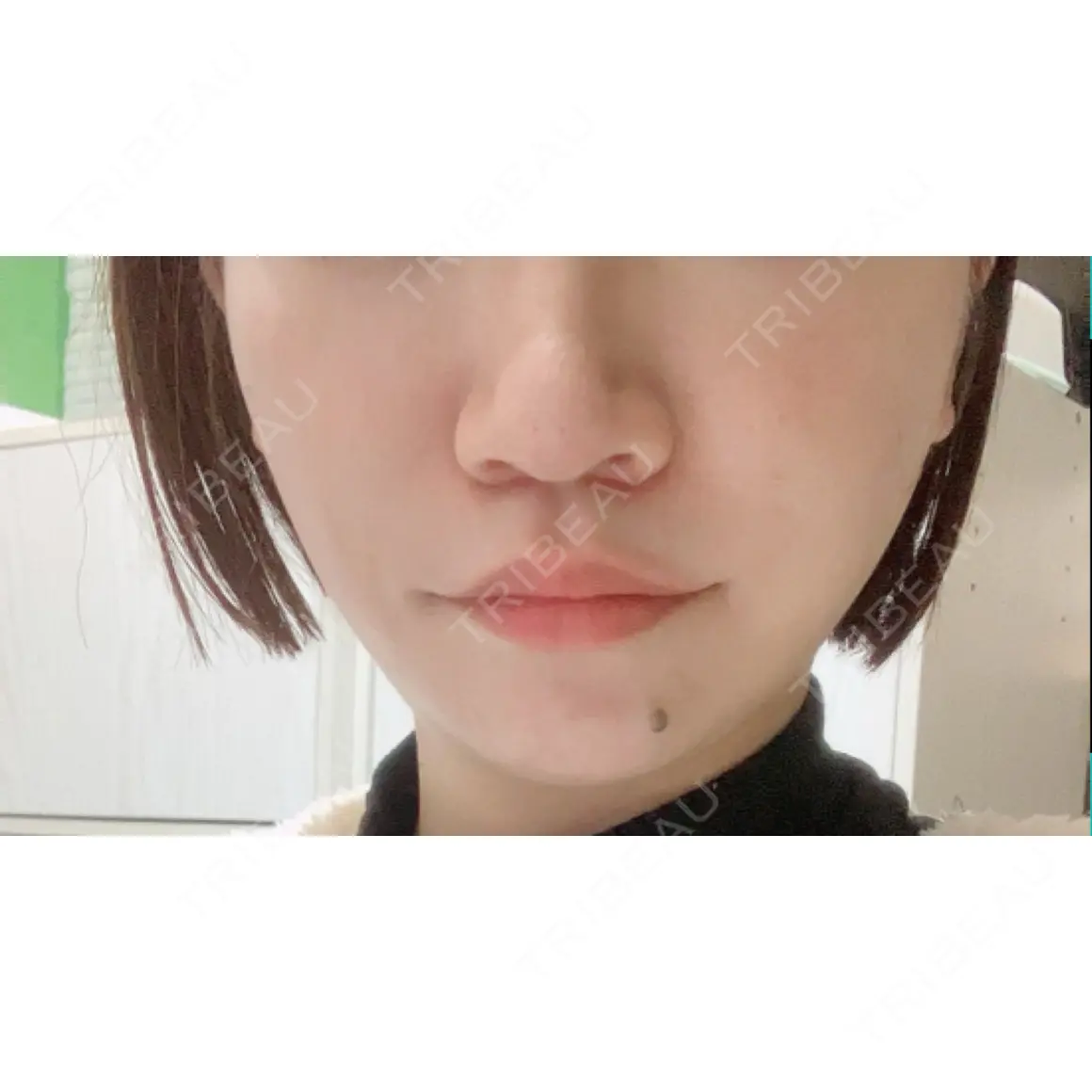 糸リフト 渋谷美容外科クリニック 渋谷院 AFTER